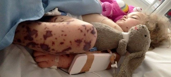 инфекционный менингит инфекционный менингит