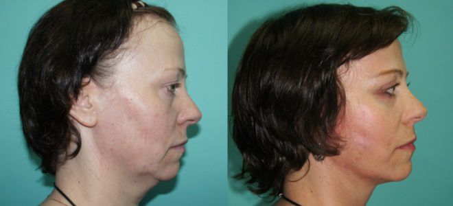 Классический СМАС лифтинг Классический СМАС лифтинг