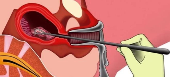 кровь в матке кровь в матке