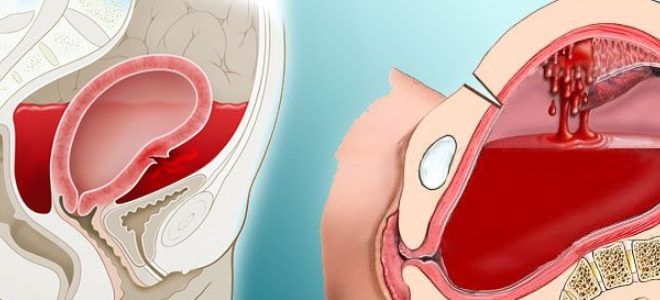 кровотечение у беременных кровотечение у беременных