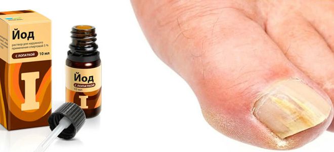 лечение грибка ногтей йодом и перекисью водорода лечение грибка ногтей йодом и перекисью водорода