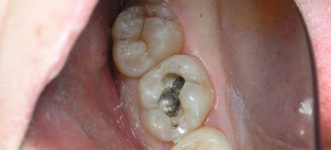 острый пульпит острый пульпит