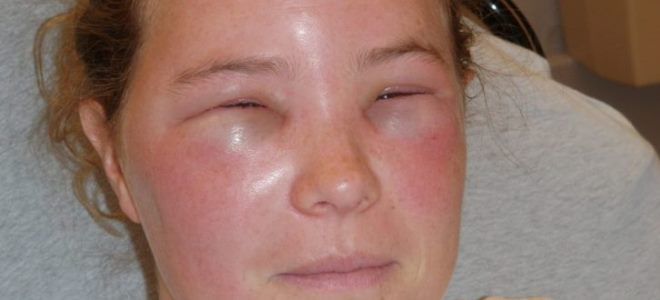 отек квинке симптомы отек квинке симптомы