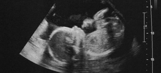 плод на 21 неделе плод на 21 неделе