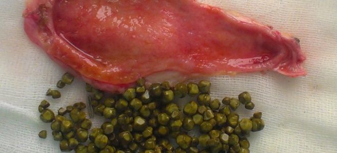 полип желчного пузыря симптомы полип желчного пузыря симптомы