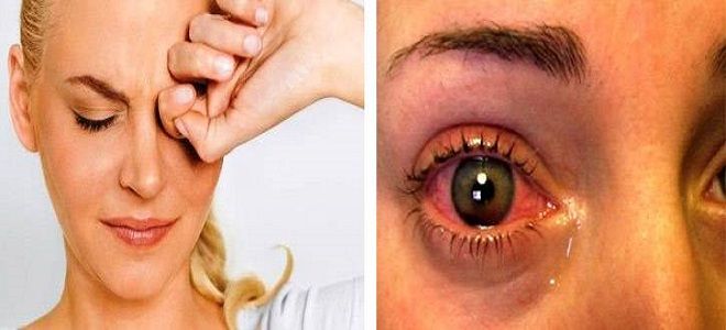 фото2 повышенное глазное давление