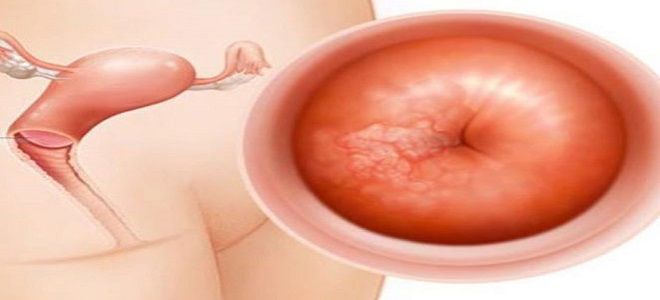 признаки лейкоплакии шейки матки признаки лейкоплакии шейки матки