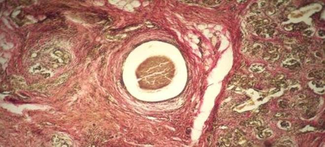 признаки муковисцидоза признаки муковисцидоза