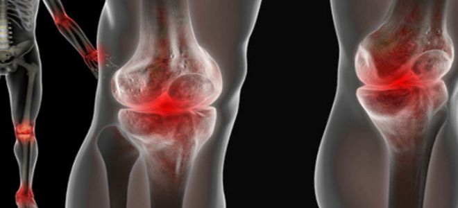 признаки ревматоидного артрита признаки ревматоидного артрита