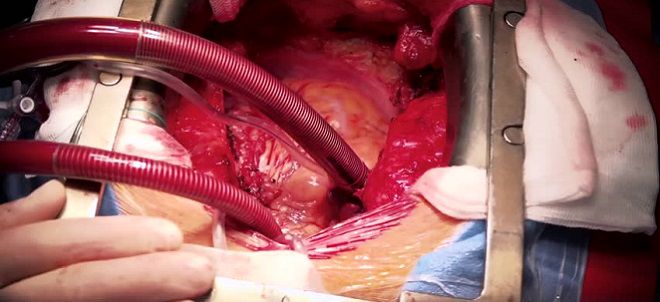 шунтирование коронарных артерий шунтирование коронарных артерий