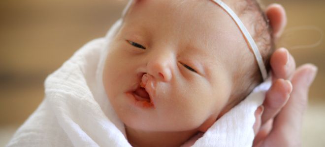 Синдром Эдвардса признаки первый Синдром Эдвардса признаки первый