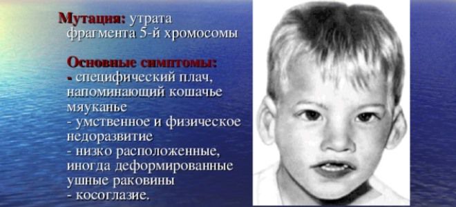 синдром кошачьего крика это синдром кошачьего крика это