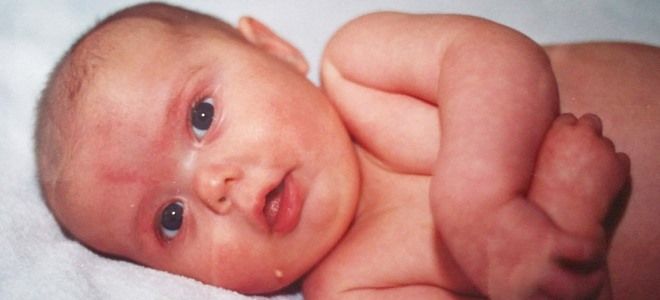 синдром маршалла у ребенка синдром маршалла у ребенка