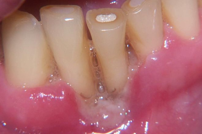 язвенный гингивит у детей язвенный гингивит у детей