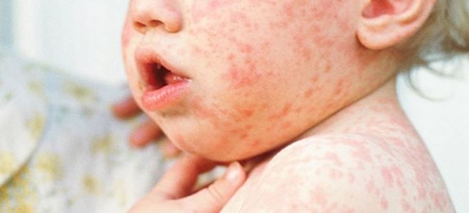 болезнь корь у детей болезнь корь у детей