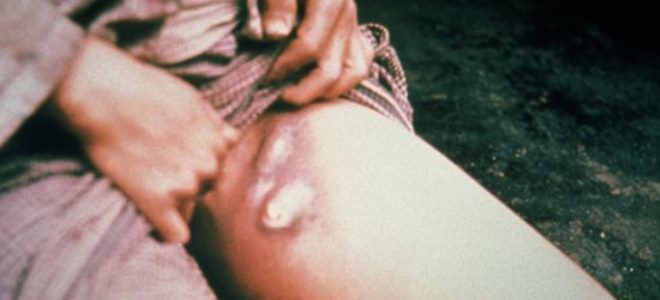 бубонная чума фото бубонная чума фото