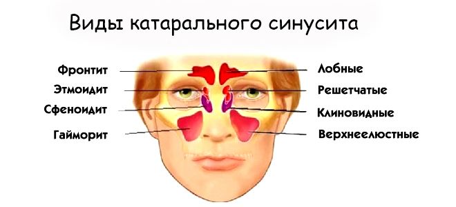 двухсторонний катаральный гайморит двухсторонний катаральный гайморит