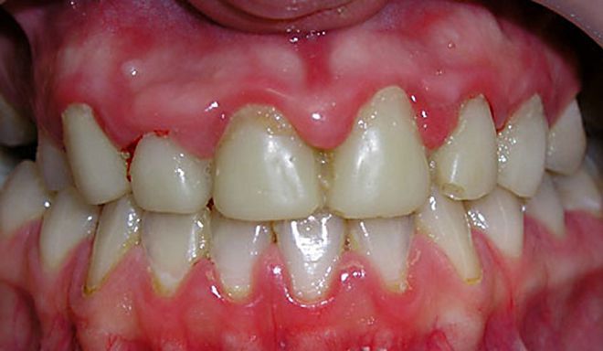 гипертрофический гингивит гипертрофический гингивит