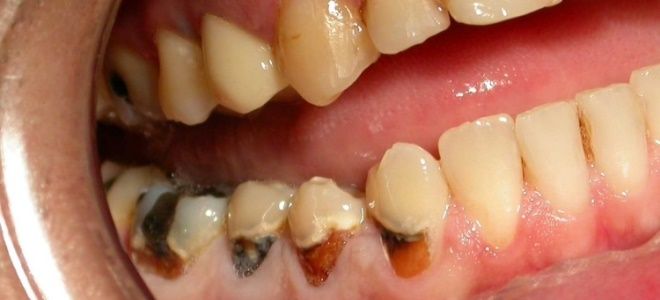 хронический пульпит хронический пульпит