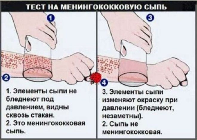 как распознать менингит как распознать менингит