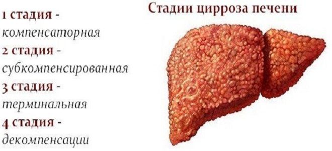 фото3 как вылечить цирроз печени
