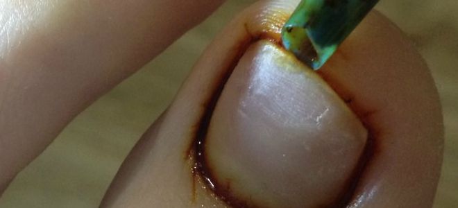 лечение грибка ногтей йодом и уксусом лечение грибка ногтей йодом и уксусом