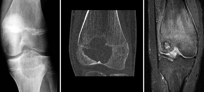мрт опухоли костей мрт опухоли костей