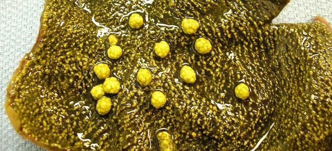 полипы в желчном пузыре лечение без операции полипы в желчном пузыре лечение без операции