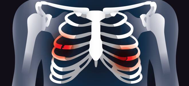 с чем путают синдром титце с чем путают синдром титце