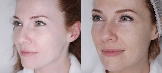 тональный крем на год процедура тональный крем на год процедура