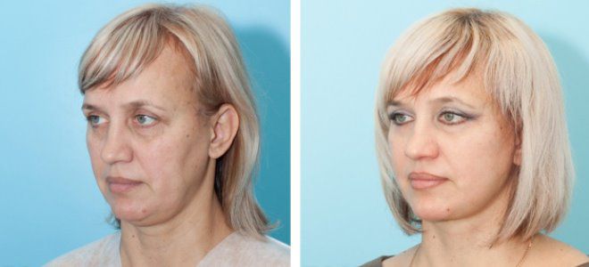 Ультразвуковой СМАС лифтинг Ультразвуковой СМАС лифтинг