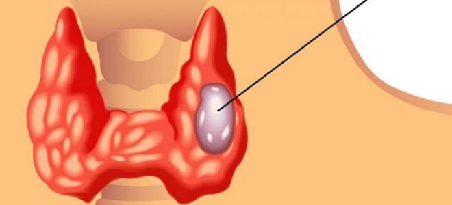 узловой зоб щитовидной узловой зоб щитовидной