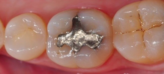 амальгамовая пломба амальгамовая пломба