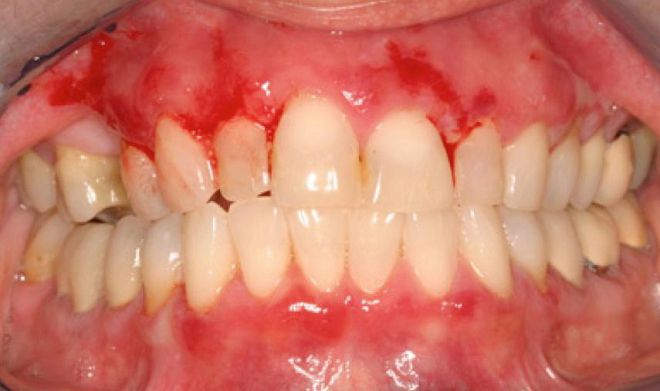 атрофический гингивит атрофический гингивит