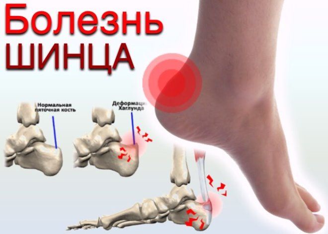 болезнь шница симптомы болезнь шница симптомы