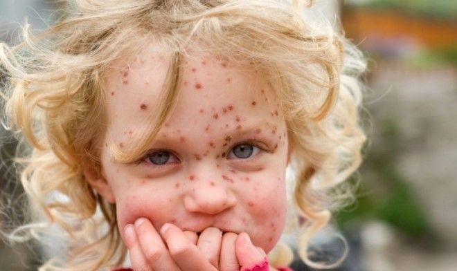 цинковая мазь при ветрянке цинковая мазь при ветрянке