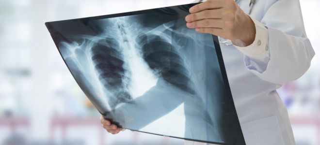 диагностика пневмонии диагностика пневмонии