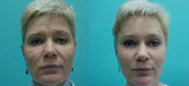 Лазерный СМАС лифтинг Лазерный СМАС лифтинг