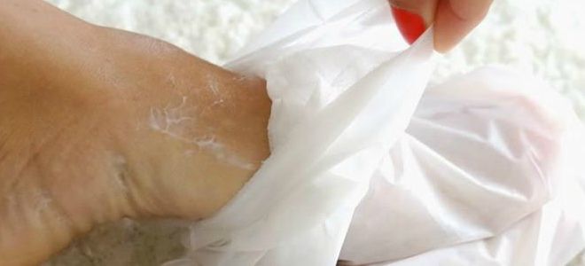 лечение грибка ногтей йодом и солью лечение грибка ногтей йодом и солью