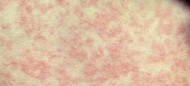 осложнения после кори осложнения после кори