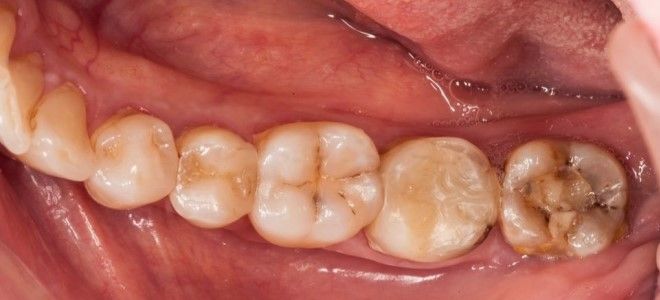 пульпит зуба мудрости пульпит зуба мудрости