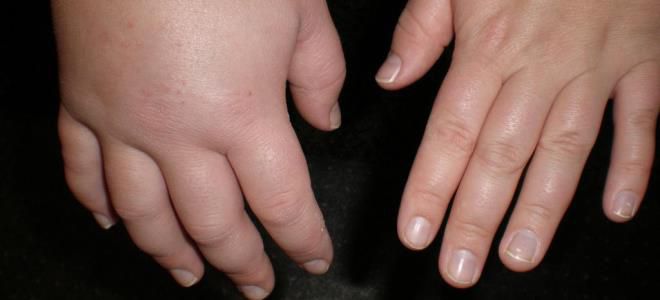 ангионевротический отек конечностей ангионевротический отек конечностей