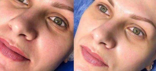 эффект тонального крема на 1 год эффект тонального крема на 1 год