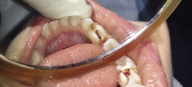 фиброзный пульпит фиброзный пульпит