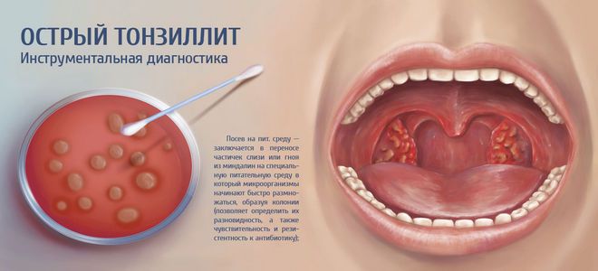 острый тонзиллит острый тонзиллит