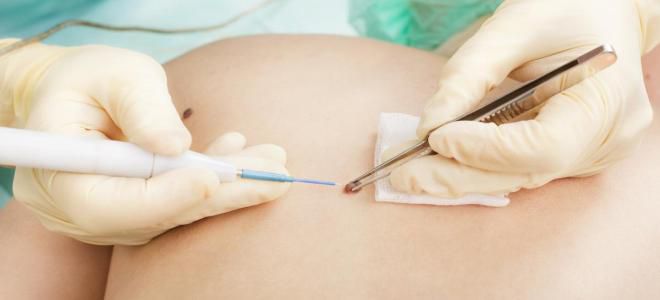 Склерозирование гемангиомы у детей Склерозирование гемангиомы у детей