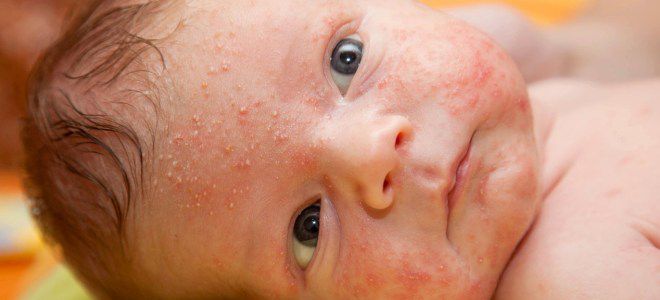 Стрептококковое импетиго у детей раз Стрептококковое импетиго у детей раз