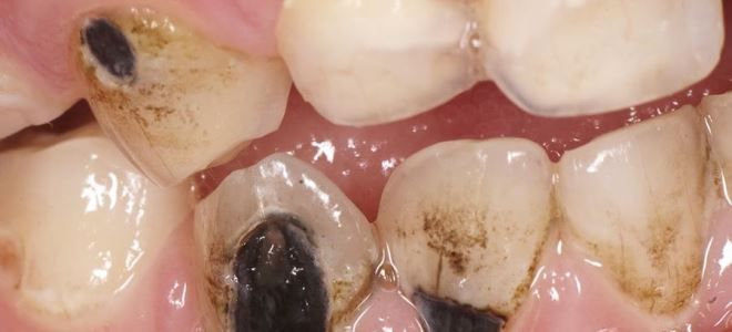 диффузный пульпит диффузный пульпит