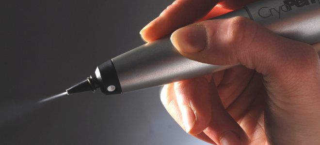 Криодеструкция гемангиомы Криодеструкция гемангиомы