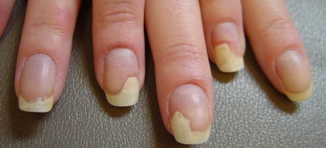 микоз ногтей на руках микоз ногтей на руках